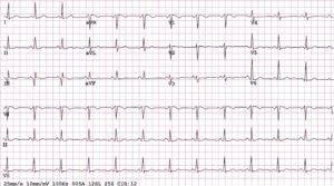 Electrocardiogram showing heart rhythm patterns.